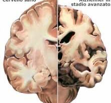 ALZHEIMER : OLTRE LA PERDITA DI MEMORIA, NUOVE SPERANZE TRA PROGRESSI TERAPEUTICI E RISCHI